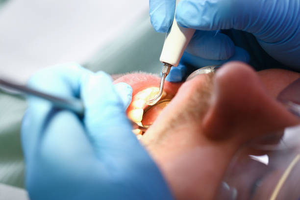 Best Emergency Dentist for Lost Fillings or Crowns in Plymouth, MI